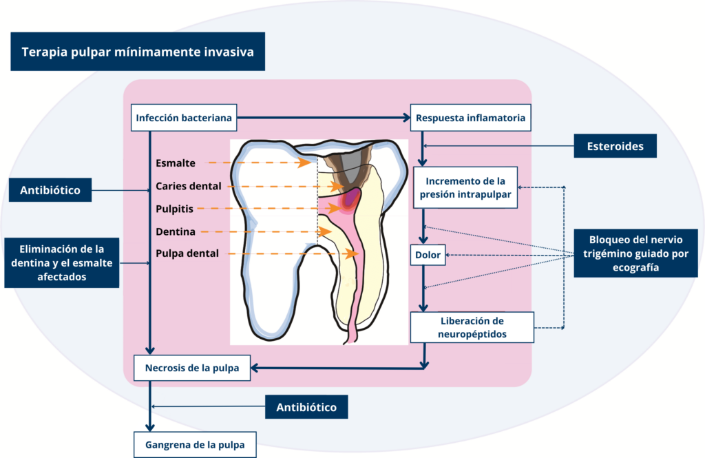 infografía terapia pulpar