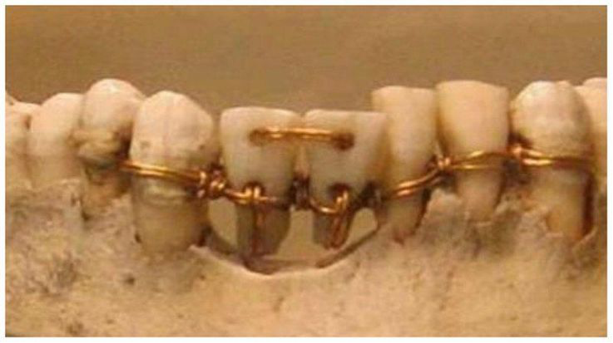 prótesis dental egipcia
