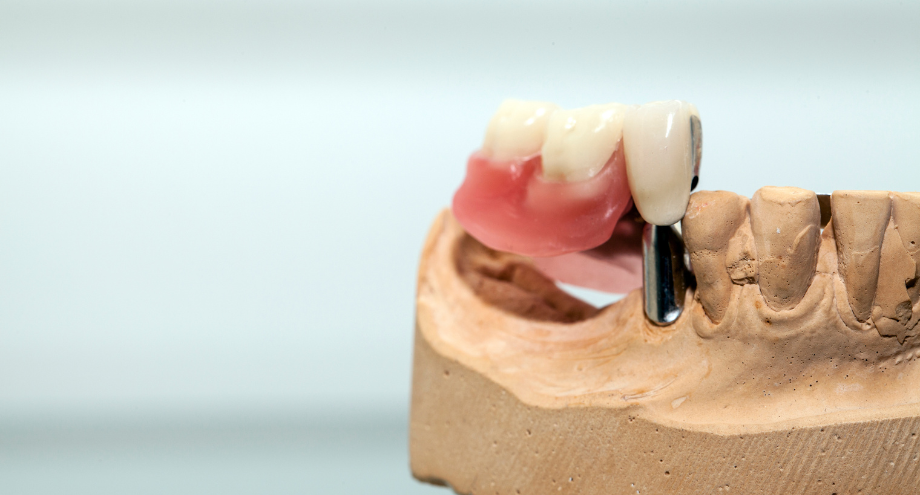 historia de la implantología oral